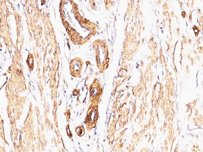 Formalin-fixed, paraffin embedded leiomyosarcoma sections stained with 100 ul anti-Actin, Smooth Muscle (clone SPM332) at 1:100. HIER epitope retrieval prior to staining was performed in 10mM Citrate, pH 6.0.